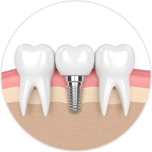 Dental Implants draw